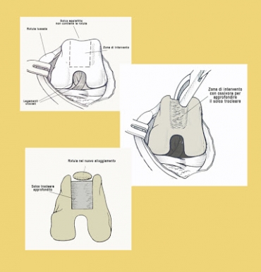 Lussazione della rotula: solcoplastica trocleare
